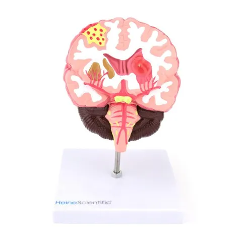 Mózg człowieka z chorobami model anatomiczny