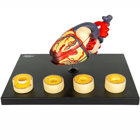 Anatomiczny model serca ze zmianami chorobowymi